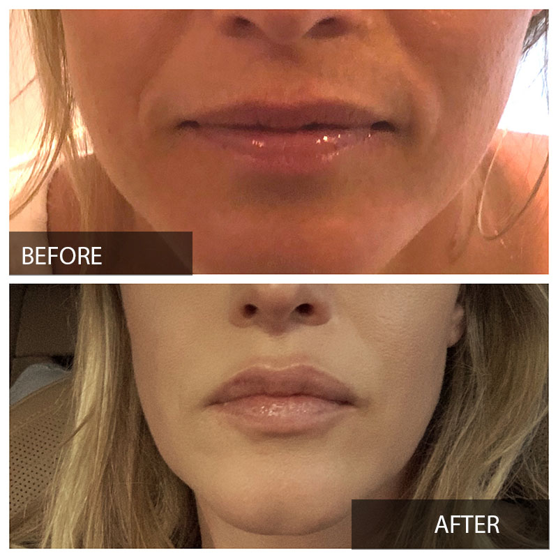 Lip Filler Before and After Worcester, MA